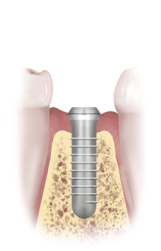 implant