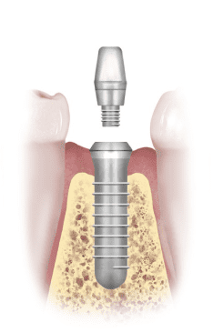 implant