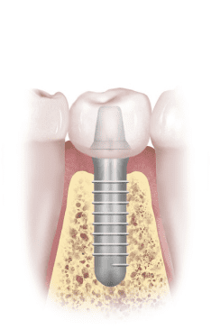 implant