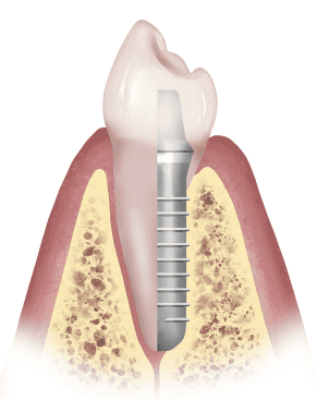 implant